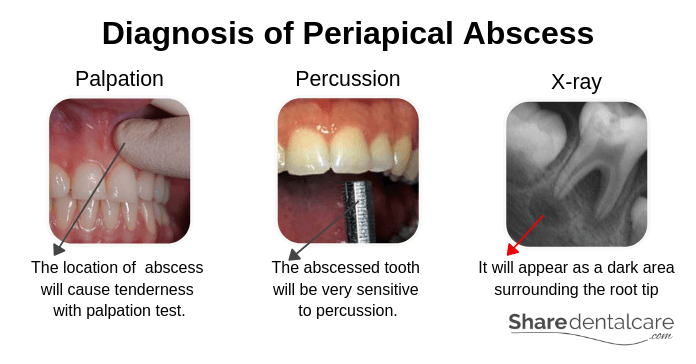 Periapical Abscess X Ray