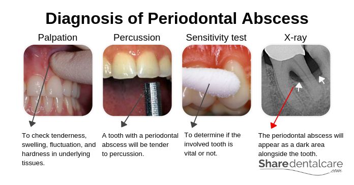 Periodontal Abscess: Symptoms & Causes [with Pictures]