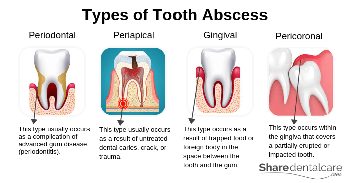 Tooth Abscess Pain