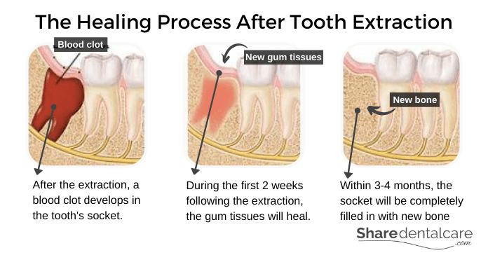 tooth aftercare clot mouth