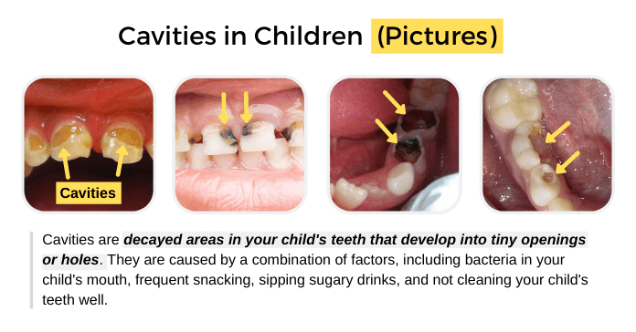 Cavities in Children (Pictures)