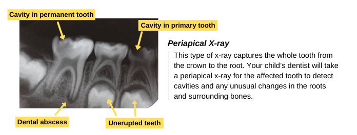 Periapical X-ray (Diagnosis)