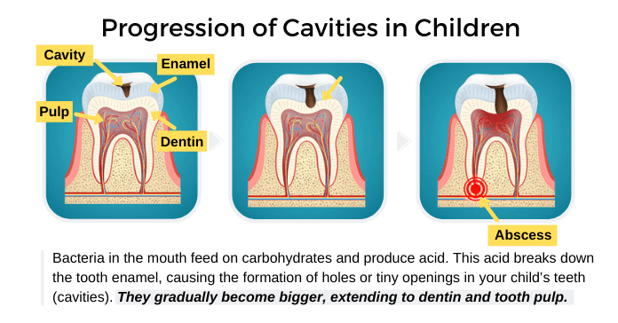 Progression of Cavities in Children