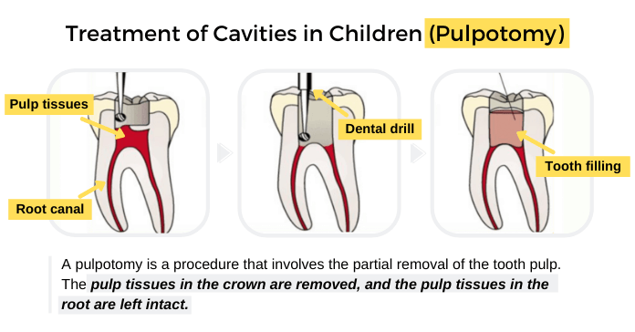 Treatment of Cavities in Children (Pulpotomy)