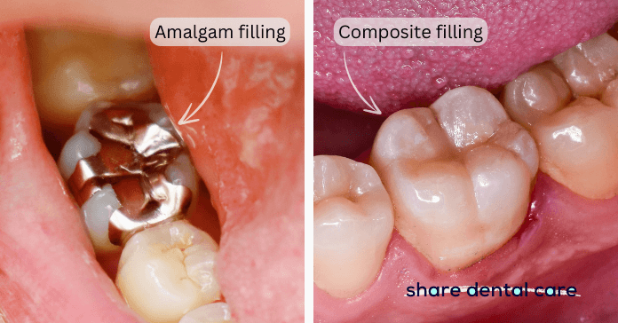 A molar with a traditional silver amalgam filling (on the left) and a molar with a tooth-colored composite filling (on the right).