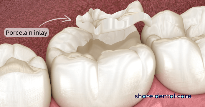 Illustration of a molar tooth with a porcelain inlay (filling)