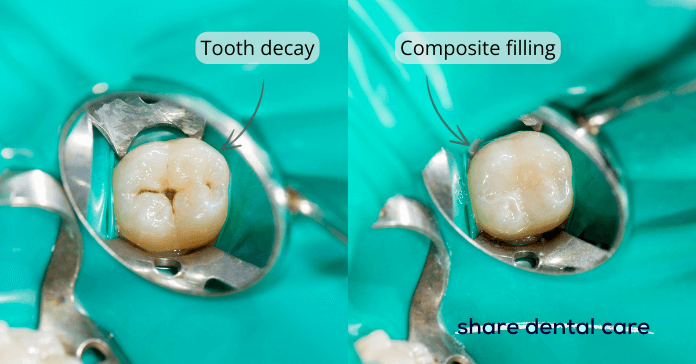 Side-by-side comparison of a molar tooth with decay on the left and restored with a composite filling by a dentist on the right.